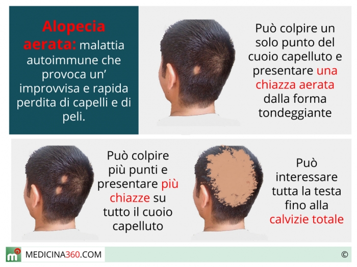 Alopecia areata: cause e cure. Maschile, femminile e nei bambini