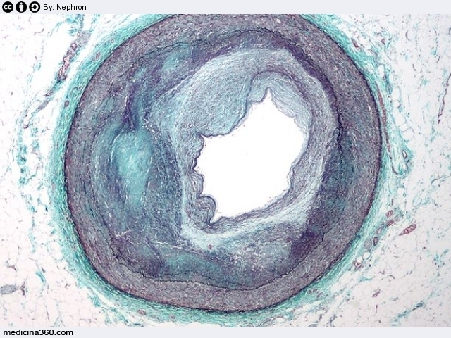 Aterosclerosi: sintomi, cause, rischi, diagnosi, cure e patogenesi