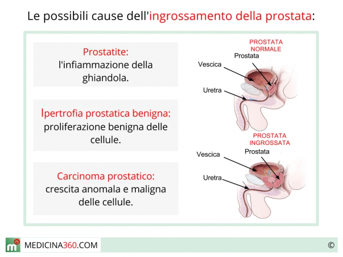 Prostata Ingrossata Sintomi Cause Rimedi E Curafisioterapia Rubiera